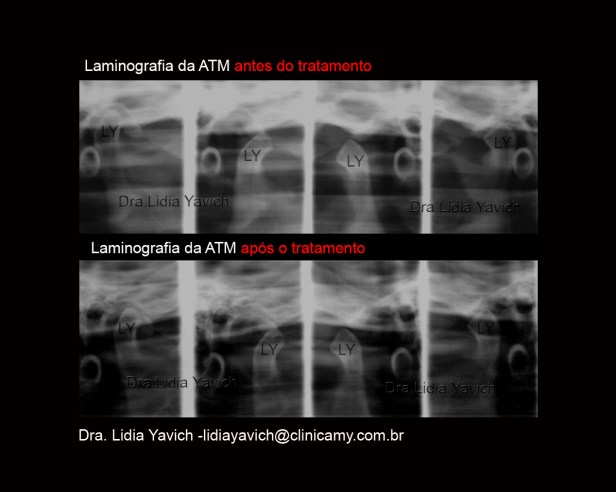 13 A LAMINOGRAFIA COMPARATIVO CRISTIANE KELLY