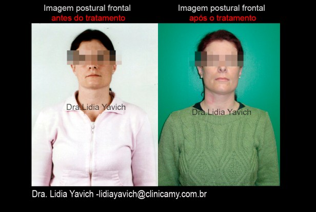 14 FOTO COMPARATIVA FRONTAL