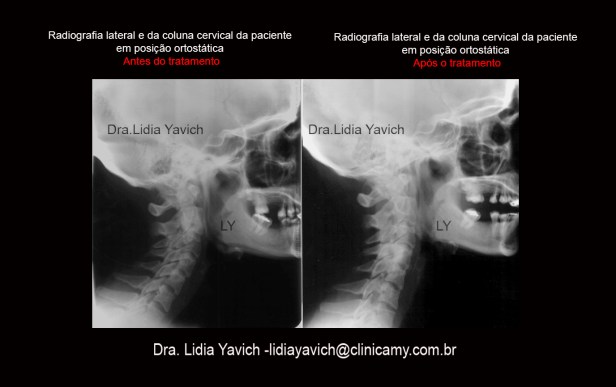 15 CERVICAL COMPARATIVO CRISTIANE KELLY