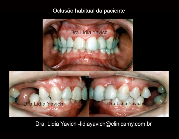 4 A DENTES