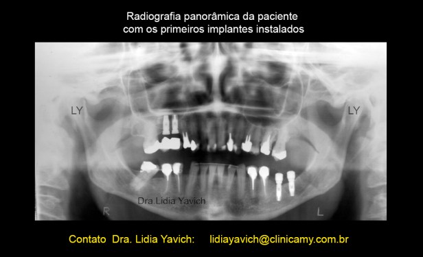 10B PANORAMICA implantes 1