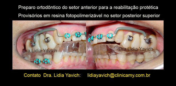 11 preparo ortodontico setor anterior