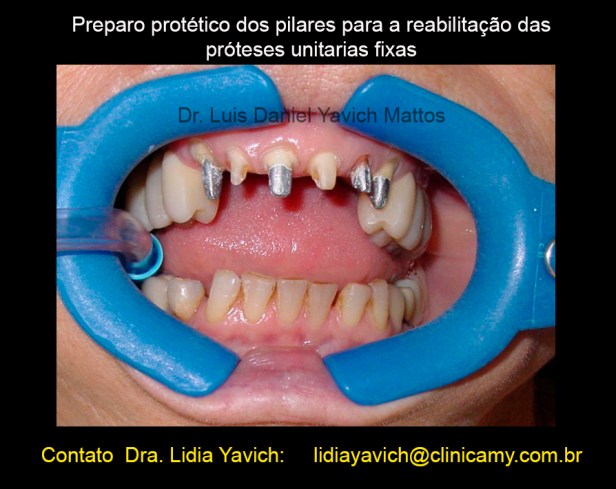 12 preparo protese-1