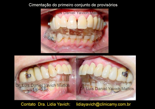 13 cimentação de coroas provisorias