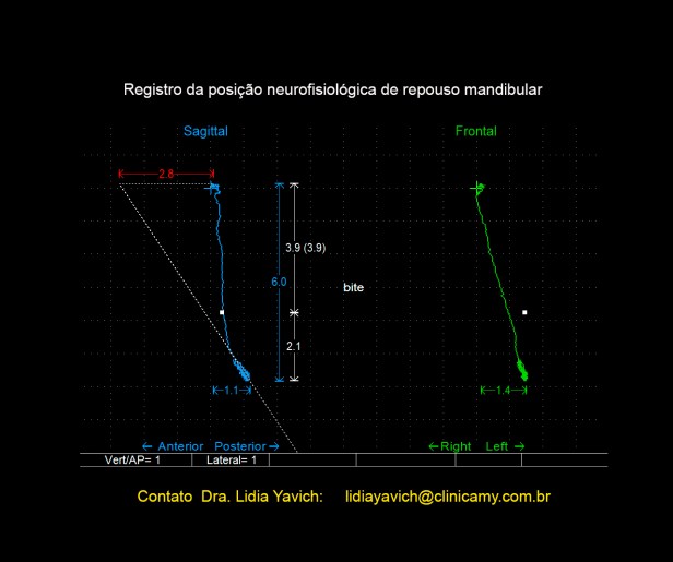 13 Registro jaw tracker-3