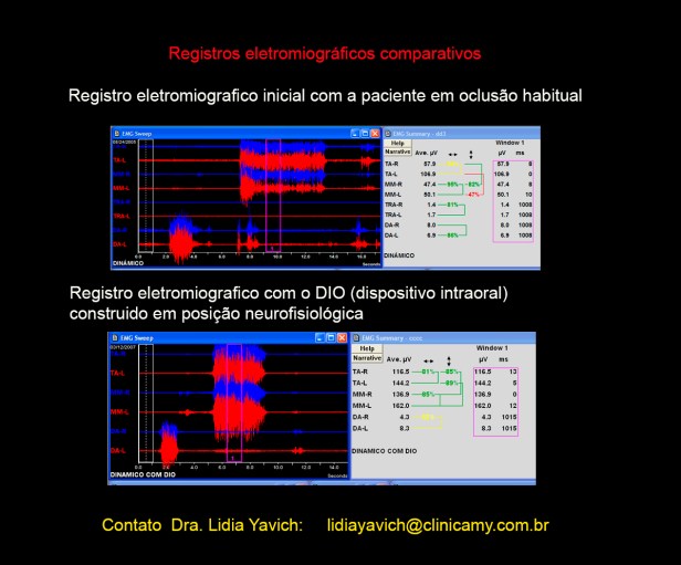 15 registro eletromiografico comparativo