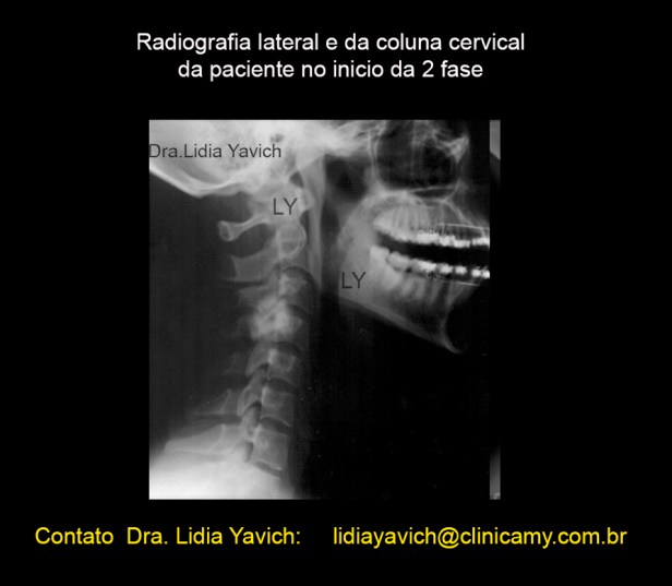 16B  LATERAL INICIO 2 FASE