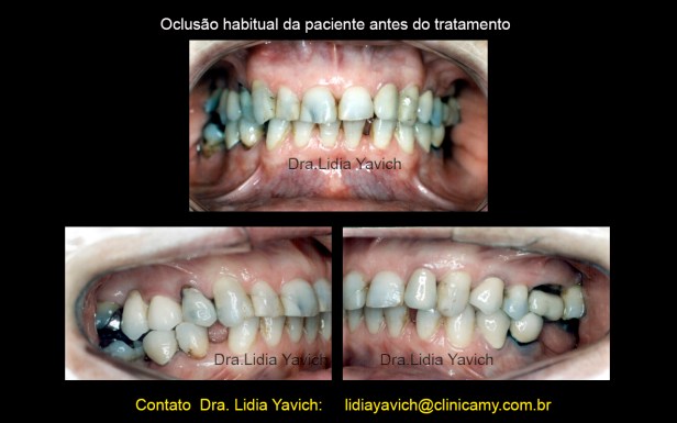 2 DENTES