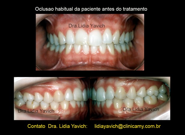 2 DENTES