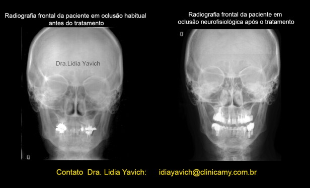 21 comparativas frontais