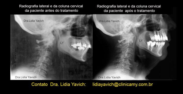 21 comparativas laterais