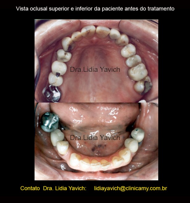 3 DENTES