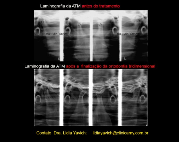 33 lamino comparativas