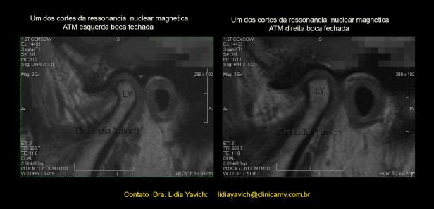 5D ressonancia boca fechada