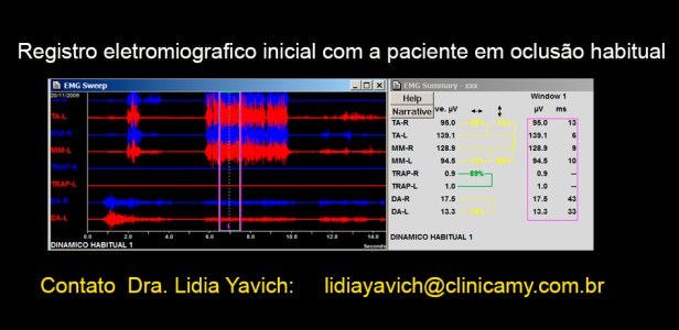 8 B eletromiografia em oc. habitual