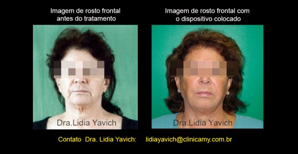 8C fotos comparativas frontais