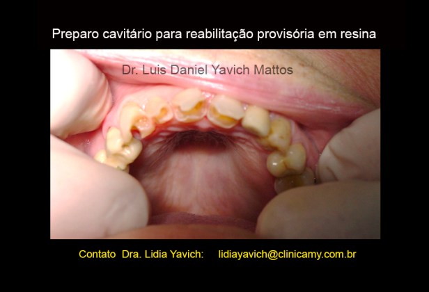 9 dentes cavidades