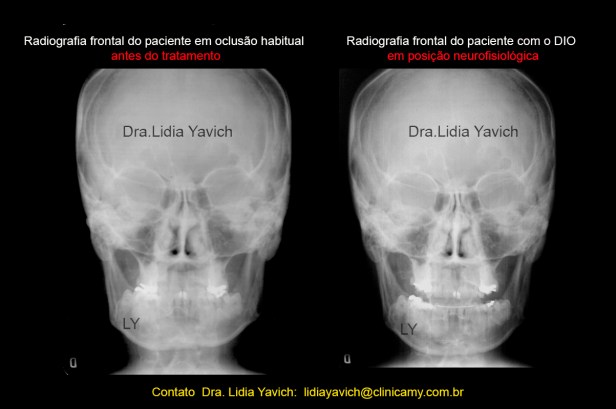 22 frontal comparativas