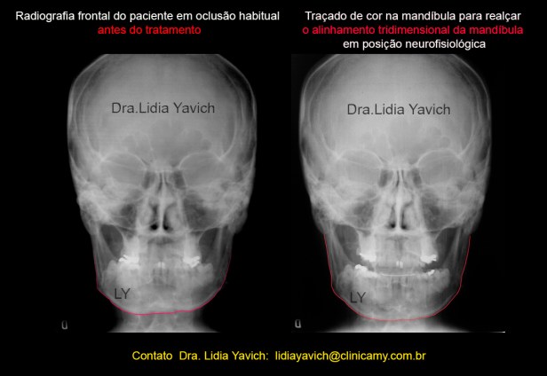 22A frontal comparativas dellinhadas
