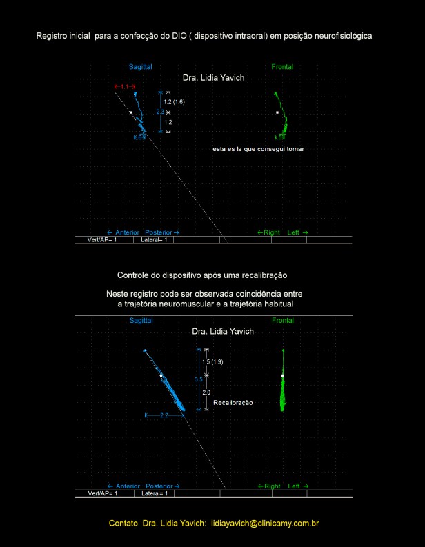 13B TOMA DE MORDIDA E RECAL