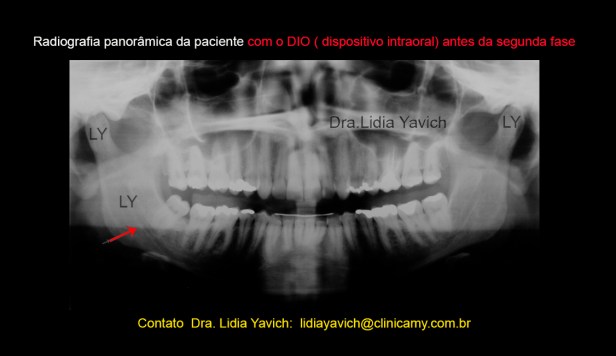 14 PANORAMICA ANTES DA ORTO