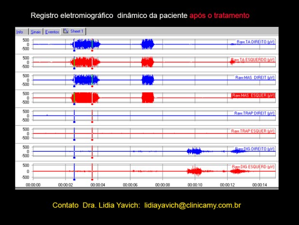 22A eletromiografia final 22A