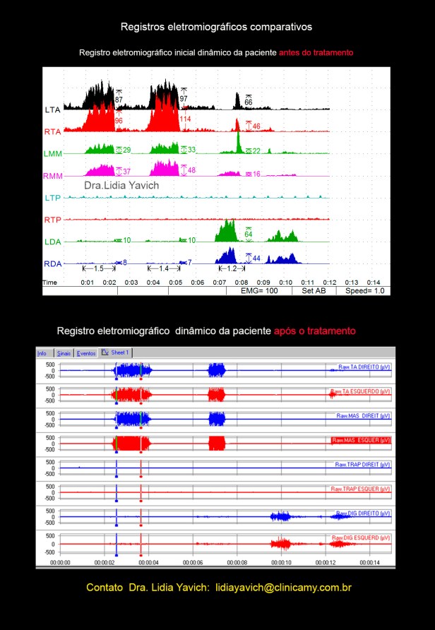 22B eletromiografia COMPARATIVA