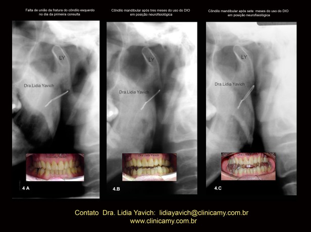 11A comparação de panorâmicas E OCLUSÃO