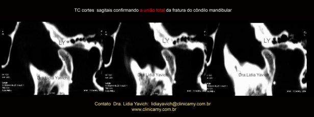 12 CORTES DE TOMOGRAFIA FINAIS
