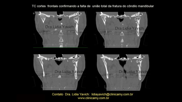 4A CORTES DE TOMOGRAFIA INICIAIS
