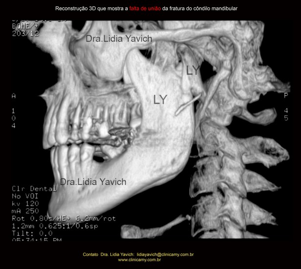 6 3D transparencia da fratura