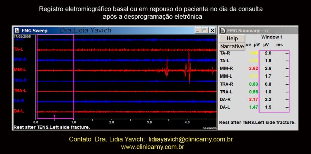 7 B ELETROMIOGRAFIA após dema
