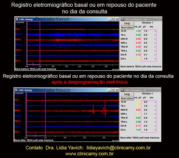 7 C ELETROMIOGRAFIA comparativas ante e apos desprogramação