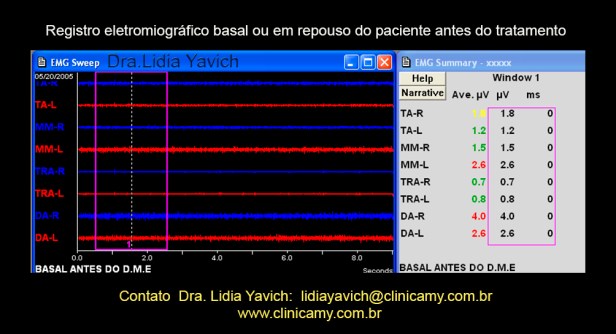10 ELETROMIOGRAFIA INICIAL ANTES DO DEM