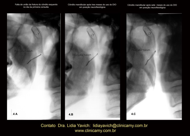 11AB comparação de panorâmicas com inversão