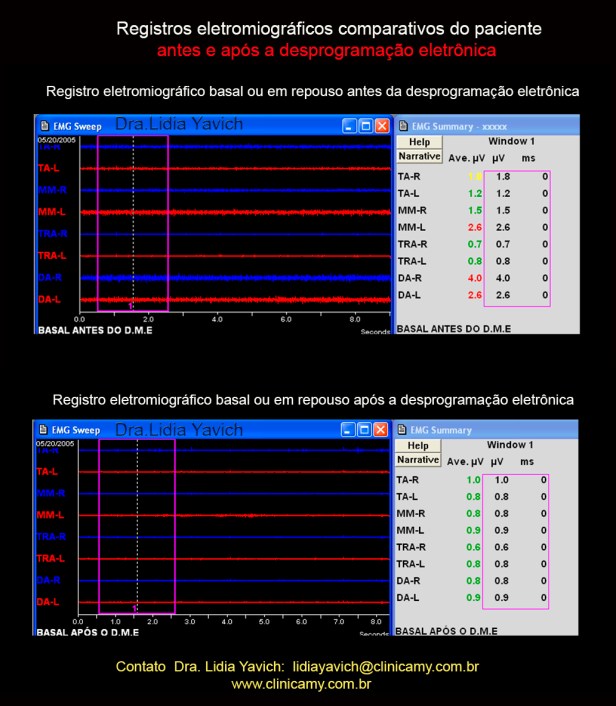 12 ELETROMIOGRAFIA INICIAIS COMPARATIVAS