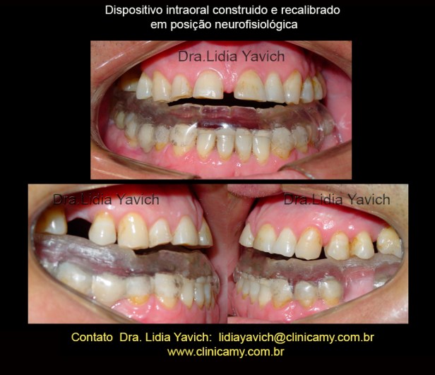 14 ORTESE RECALIBRADA