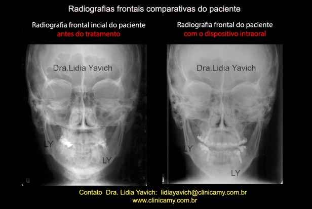 16 bRADIOGRAFIAS FRONTAL COMPARATIVAS