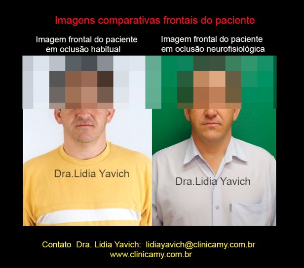 16 FRONTAL COMPARATIVOS