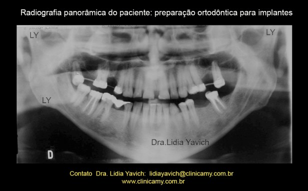 19 PANORAMICA PREPARO PARA IMPLANTES 1