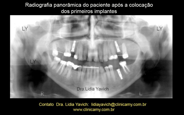 19b PANORAMICA IMPLANTES 1