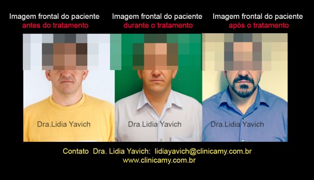 35 frontais comparativos 22