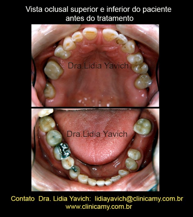 4 OCLUSAL