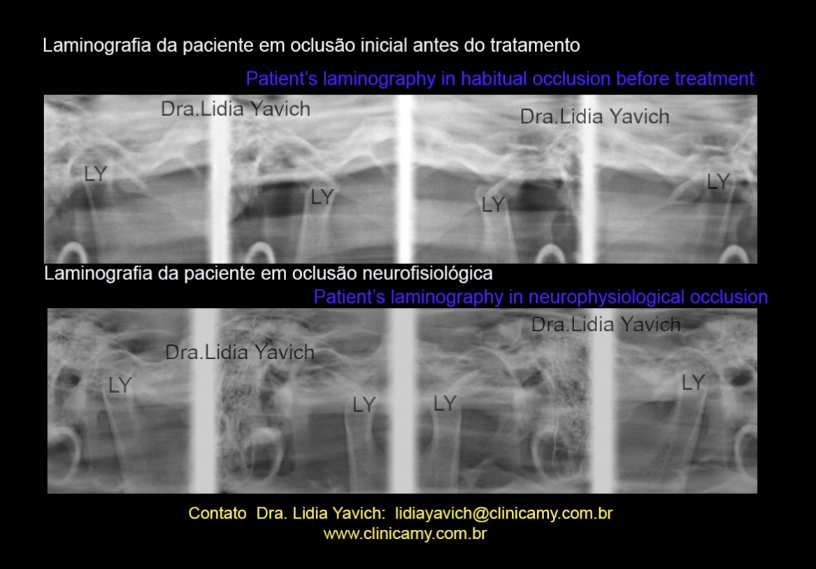 32 lamino comparativas