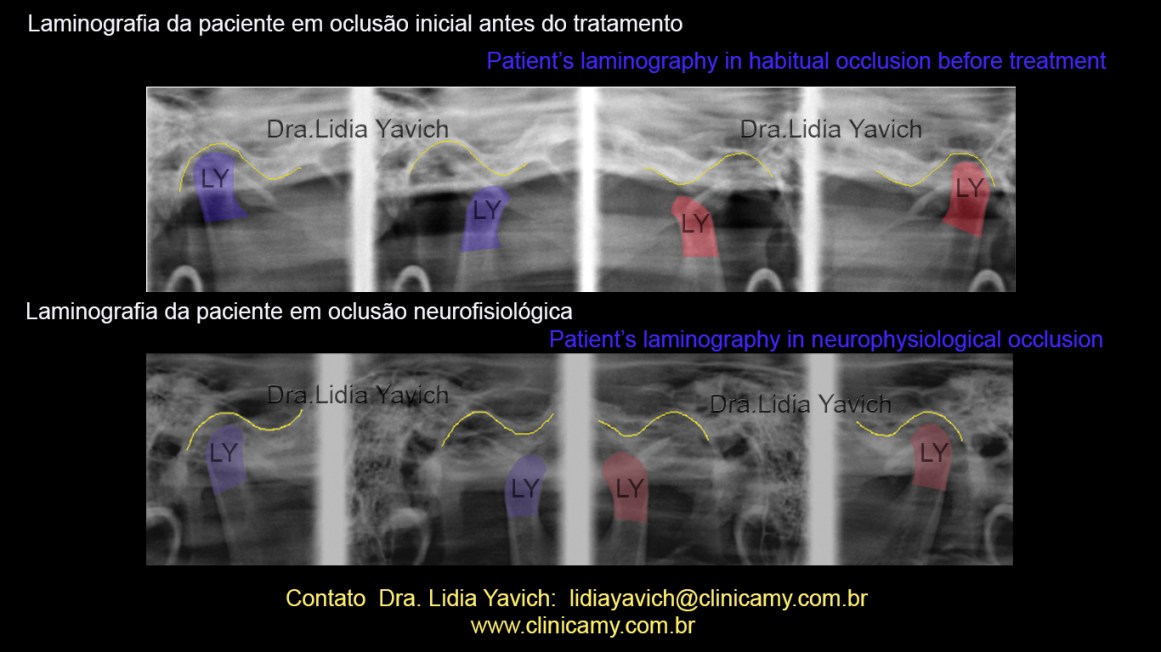 33 lamino comparativas COR