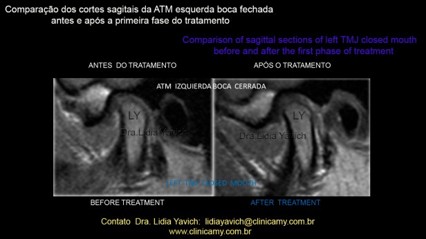 36 RNM AFTER TREATMENT