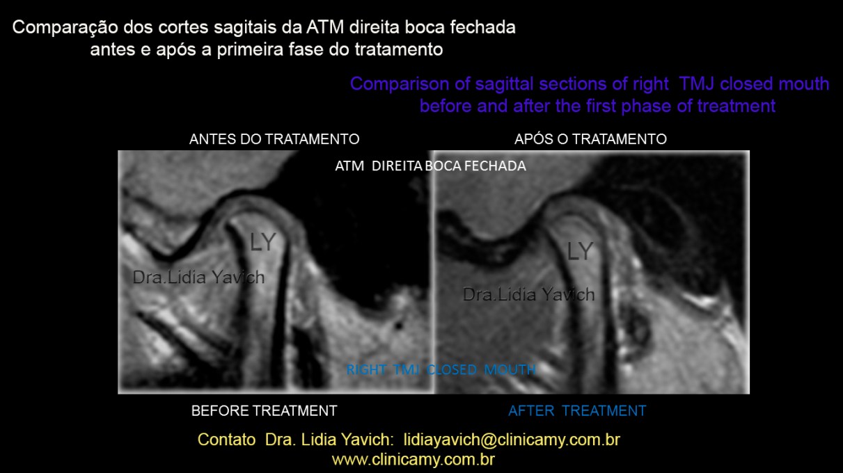 42 RNM AFTER TREATMENT
