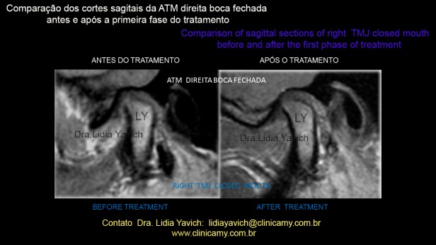 44 RNM AFTER TREATMENT