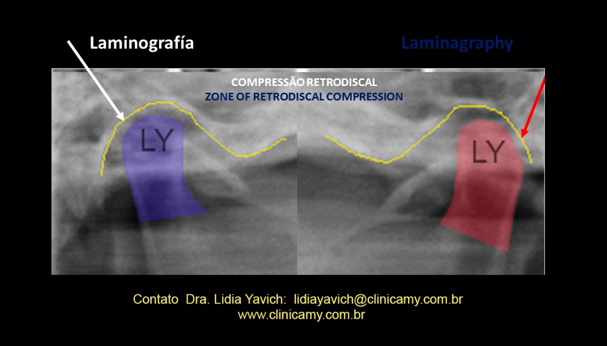 9 ampliação laminografia