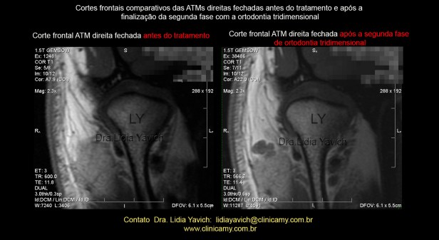 30 ress comparativa frontal dir 1